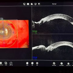 Optical Coherence Tomography del trapianto endoteliale